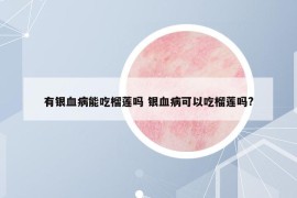 有银血病能吃榴莲吗 银血病可以吃榴莲吗?