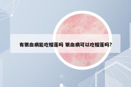 有银血病能吃榴莲吗 银血病可以吃榴莲吗?