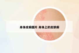 身体皮癣图片 身体上的皮肤癣