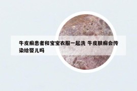 牛皮癣患者和宝宝衣服一起洗 牛皮肤癣会传染给婴儿吗