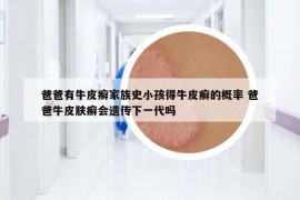 爸爸有牛皮癣家族史小孩得牛皮癣的概率 爸爸牛皮肤癣会遗传下一代吗
