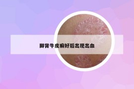脚背牛皮癣好后出现出血