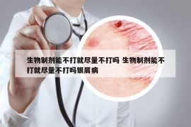 生物制剂能不打就尽量不打吗 生物制剂能不打就尽量不打吗银屑病