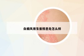 白癜风用生姜擦患处怎么样