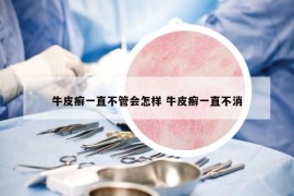 牛皮癣一直不管会怎样 牛皮癣一直不消