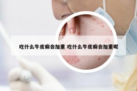 吃什么牛皮癣会加重 吃什么牛皮癣会加重呢