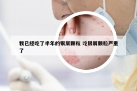 我已经吃了半年的银屑颗粒 吃银屑颗粒严重了