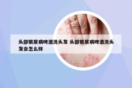 头部银屑病啤酒洗头发 头部银屑病啤酒洗头发会怎么样