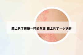 腰上长了像癣一样的东西 腰上长了一小块癣