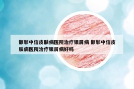 邯郸中信皮肤病医院治疗银屑病 邯郸中信皮肤病医院治疗银屑病好吗