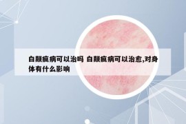白颠疯病可以治吗 白颠疯病可以治愈,对身体有什么影响