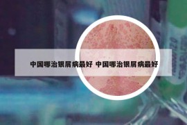 中国哪治银屑病最好 中国哪治银屑病最好