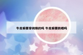牛皮癣要穿纯棉的吗 牛皮癣要防晒吗