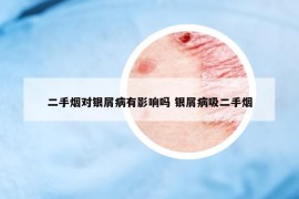 二手烟对银屑病有影响吗 银屑病吸二手烟