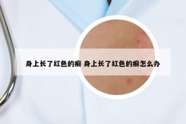 身上长了红色的癣 身上长了红色的癣怎么办