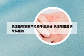 天津是哪家医院能看牛皮癣好 天津看银屑病专科医院