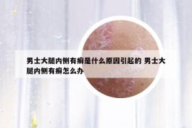 男士大腿内侧有癣是什么原因引起的 男士大腿内侧有癣怎么办