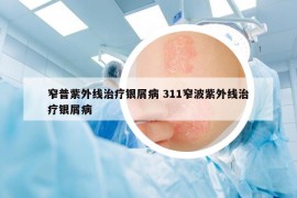 窄普紫外线治疗银屑病 311窄波紫外线治疗银屑病