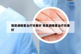 银屑病哪里治疗效果好 银屑病哪里治疗效果好
