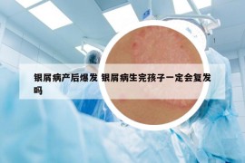 银屑病产后爆发 银屑病生完孩子一定会复发吗