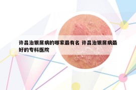 许昌治银屑病的哪家最有名 许昌治银屑病最好的专科医院