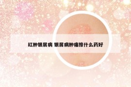 红肿银屑病 银屑病肿痛擦什么药好