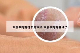 银屑病疙瘩什么时候消 银屑病疙瘩变硬了