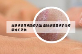 皮肤病银屑病治疗方法 皮肤病银屑病的治疗最好的药物