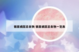 银屑病禁忌食物 银屑病禁忌食物一览表