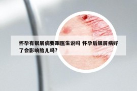 怀孕有银屑病要跟医生说吗 怀孕后银屑病好了会影响胎儿吗?