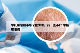 掌托脓包病半年了医生也开药一直不好 掌拖脓包病