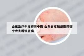 山东治疗牛皮癣老中医 山东省皮肤病医院哪个大夫看银屑病