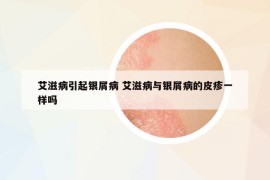 艾滋病引起银屑病 艾滋病与银屑病的皮疹一样吗