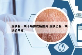 皮肤有一块干燥像皮癣图片 皮肤上有一块一块的干皮