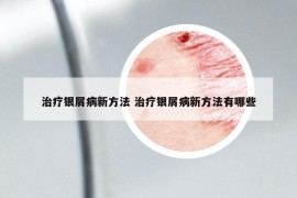 治疗银屑病新方法 治疗银屑病新方法有哪些