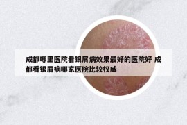 成都哪里医院看银屑病效果最好的医院好 成都看银屑病哪家医院比较权威
