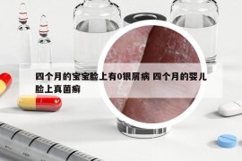 四个月的宝宝脸上有0银屑病 四个月的婴儿脸上真菌癣