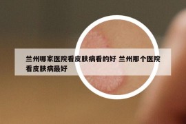 兰州哪家医院看皮肤病看的好 兰州那个医院看皮肤病最好