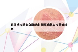 银屑病皮肤变白斑蜕皮 银屑病起白皮是好转么