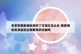 寻常性银屑病皮损好了又发红怎么办 银屑病皮损消退后还需要用药巩固吗
