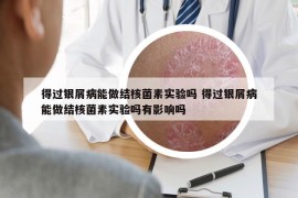 得过银屑病能做结核菌素实验吗 得过银屑病能做结核菌素实验吗有影响吗