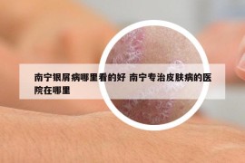 南宁银屑病哪里看的好 南宁专治皮肤病的医院在哪里