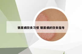银屑病饮食习惯 银屑病的饮食指导