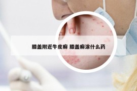 膝盖附近牛皮癣 膝盖癣涂什么药