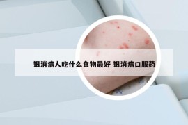 银消病人吃什么食物最好 银消病口服药