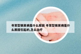 寻常型银屑病是什么原因 寻常型银屑病是什么原因引起的,怎么治疗