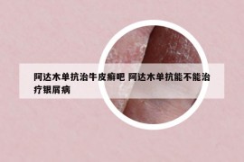 阿达木单抗治牛皮癣吧 阿达木单抗能不能治疗银屑病