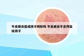 牛皮癣会造成孩子畸形吗 牛皮癣会不会传染给孩子
