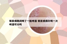银屑病期间喝了一瓶啤酒 银屑病偶尔喝一次啤酒可以吗