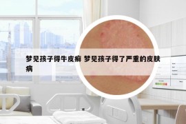 梦见孩子得牛皮癣 梦见孩子得了严重的皮肤病